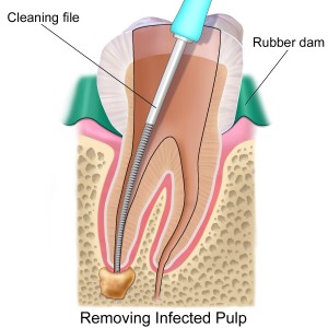 root canals pic1